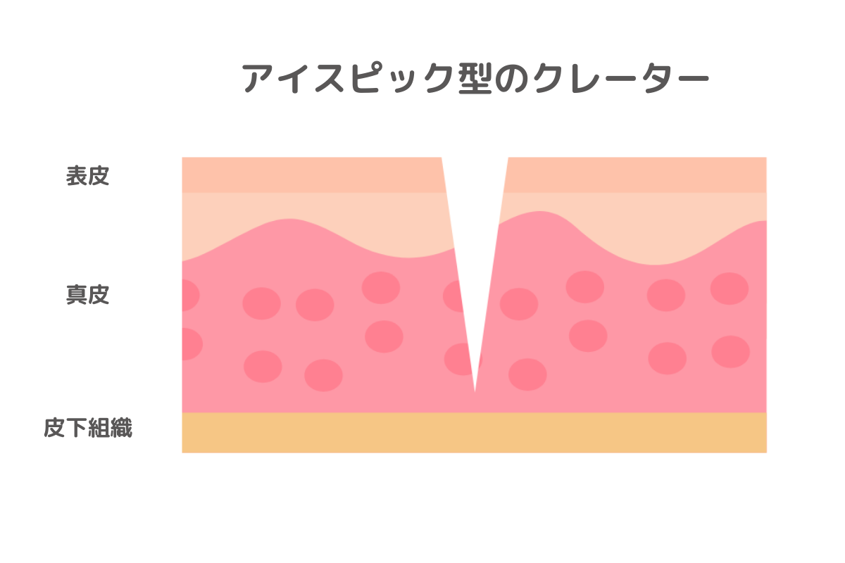 アイスピック型のクレーター