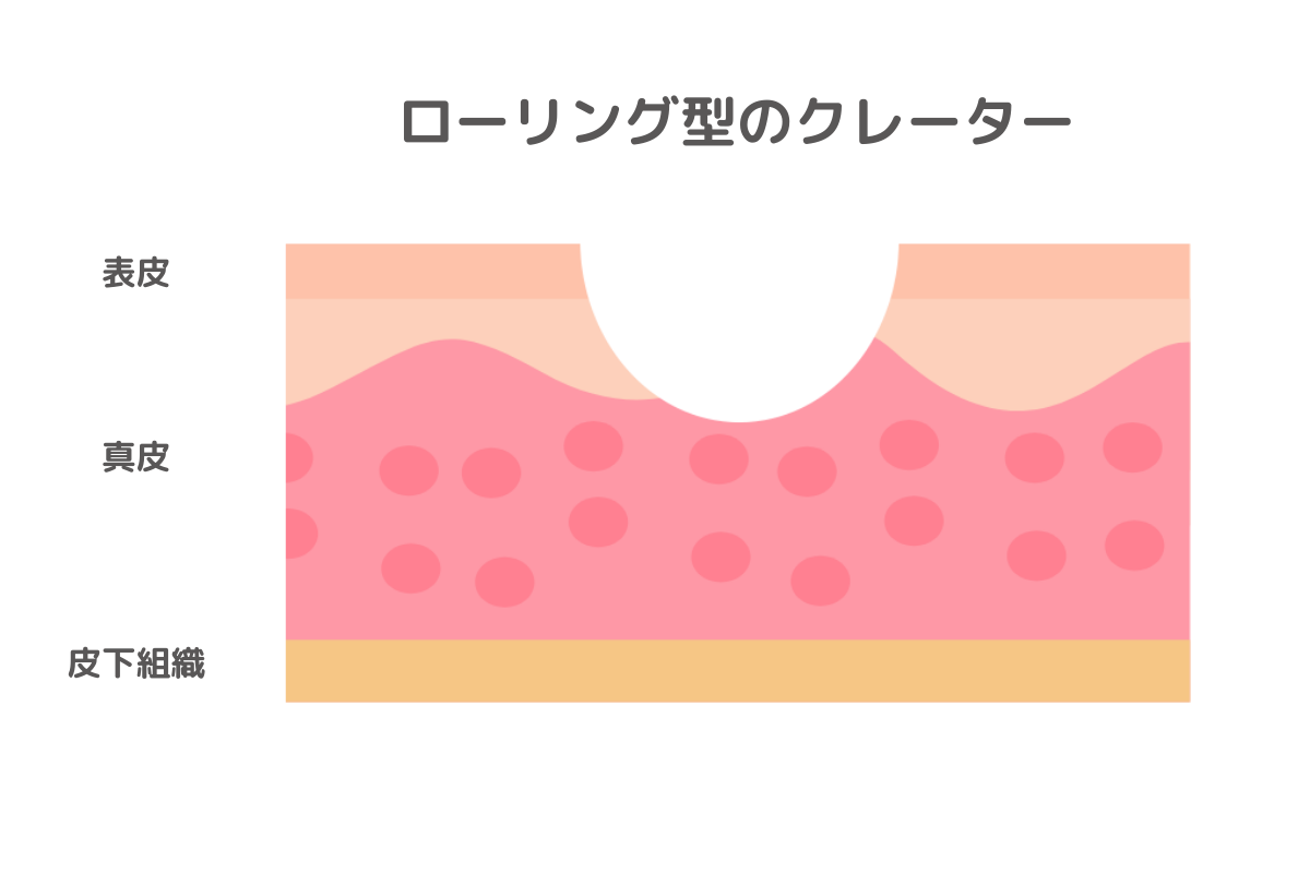 ローリング型のクレーター