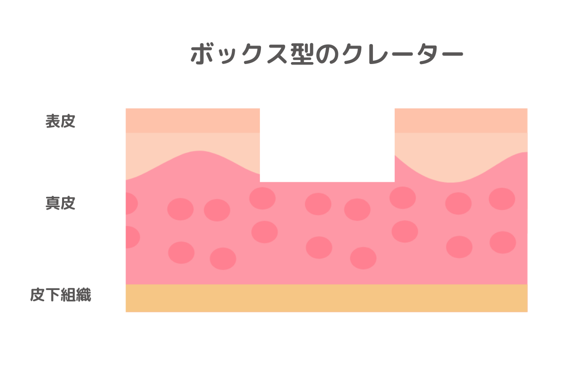 ボックス型のクレーター